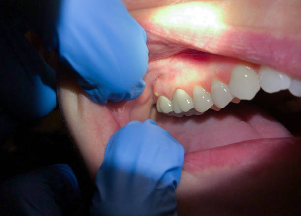 Best Lost Filling or Crown Replacement in Lden, MA